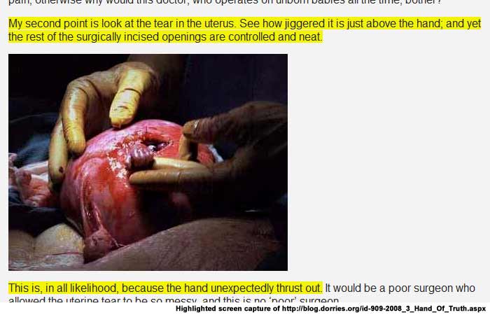 screen capture of the Hand of Hope image and accompanying text by Dorries